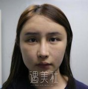 王志军全切双眼皮修复案例：失败一次更要慎重! width=