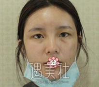 黄名斗割双眼皮案例，大眼睛代替小眼睛的美好体验 width=