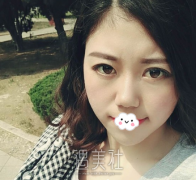 威海董立鹏双眼皮案例：再也不需要双眼皮贴啦~ width=