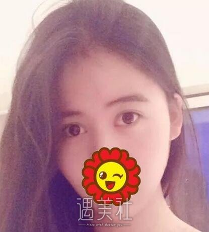 义乌张小红,双眼皮