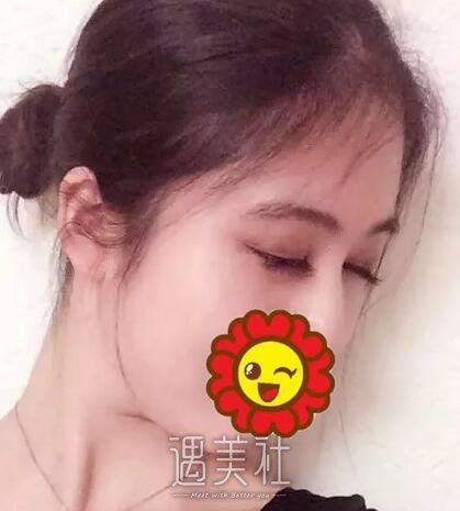 义乌张小红,双眼皮