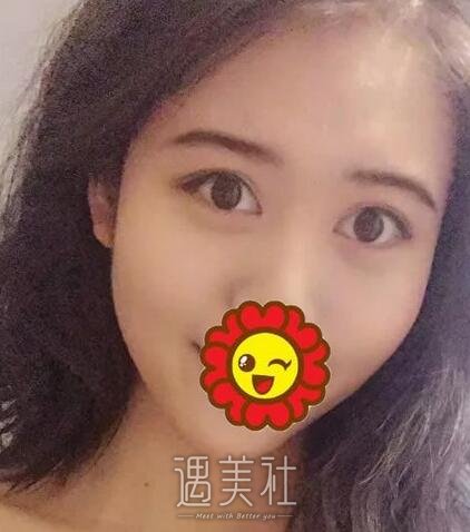义乌张小红,双眼皮