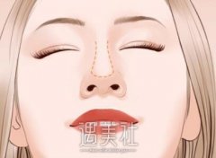 上海做朝天鼻矫正手术多少钱？看看这几点就知道了~ width=