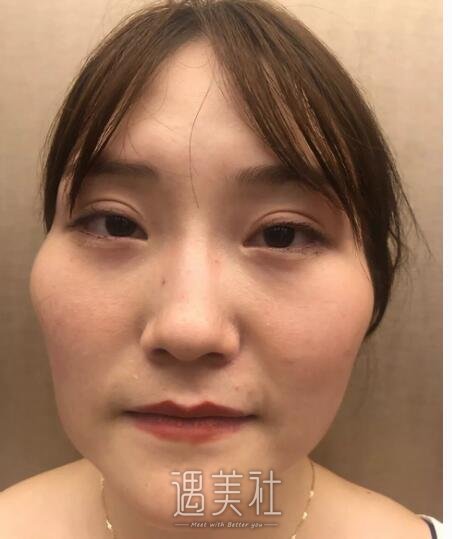 上海,首尔丽格,磨骨