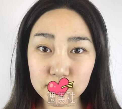冯斌,吸脂