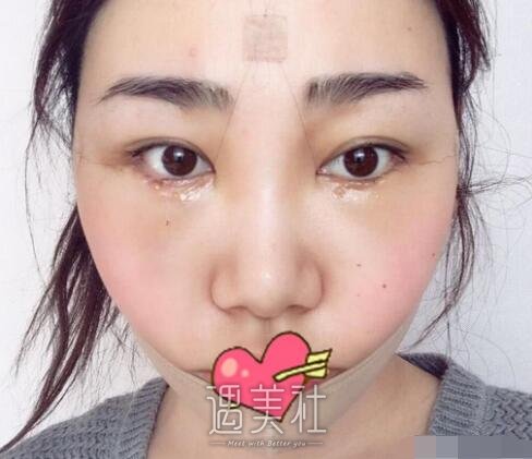 冯斌,吸脂