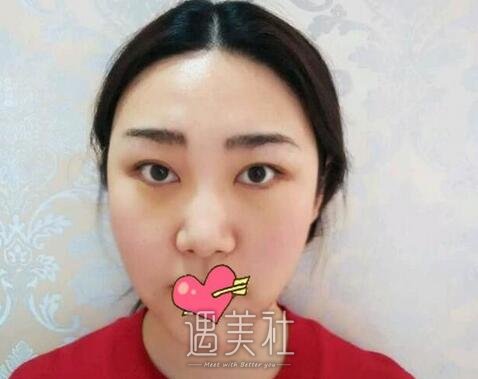 冯斌,吸脂