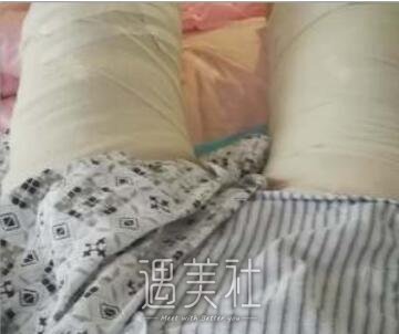 大腿环吸