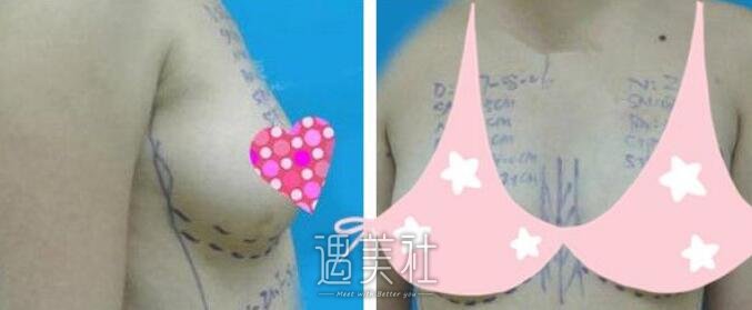 上海,伊莱美,江华,隆胸