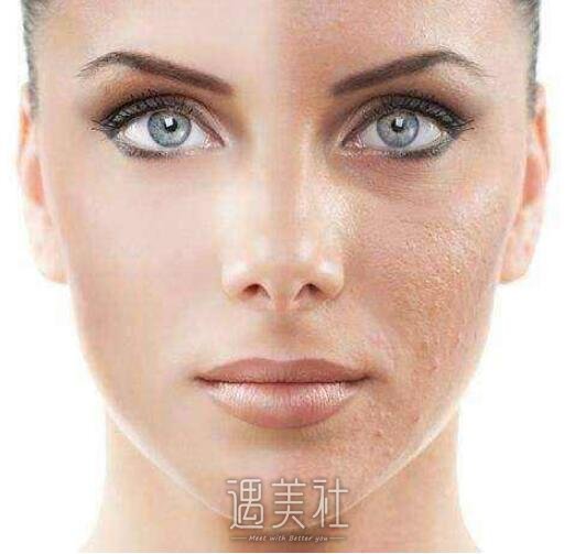 光子嫩肤术后应该如何保养，要注意哪些事情?