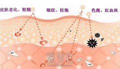 光子嫩肤果真的好吗，做几次有果? width=