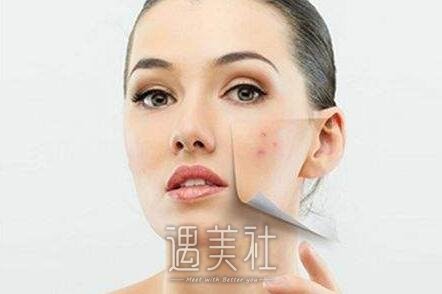 光子嫩肤果真的好吗，做几次有果?