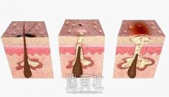 激光祛痘印痘坑有果吗，做几次有果? width=