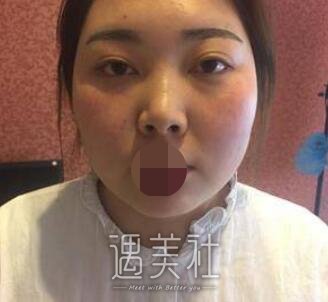 面部吸脂