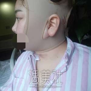 面部吸脂