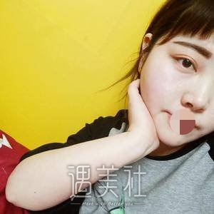 面部吸脂