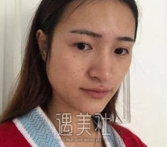 下颌角截骨手术