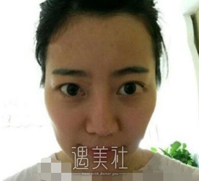 李发成,自体脂肪填充