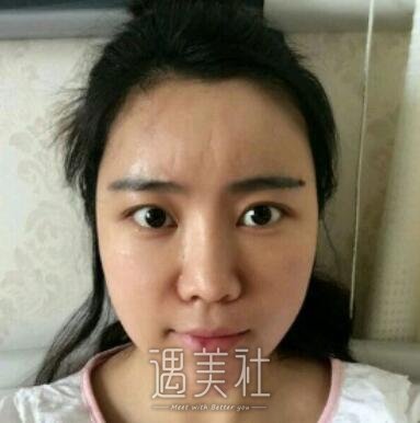 李发成,自体脂肪填充