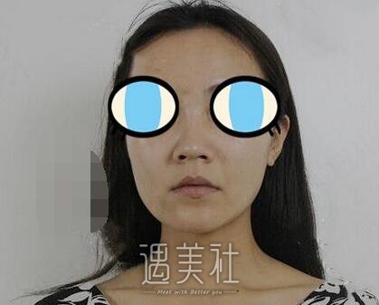 赵延勇,隆鼻
