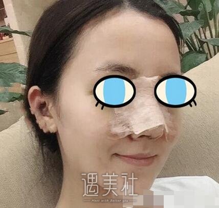 赵延勇,隆鼻