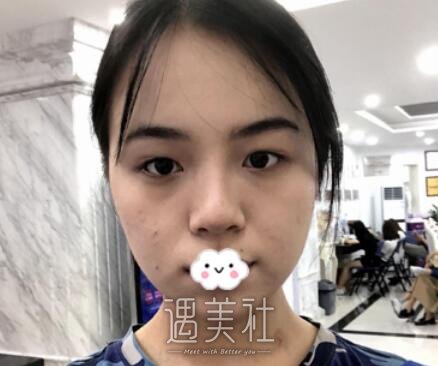 上海,九院,施耀明,双眼皮