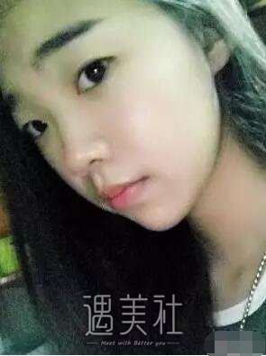 田芳斌双眼皮案例：从此告别丑丑的单眼皮小眼睛~