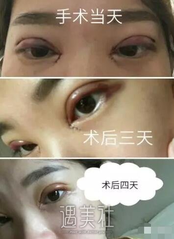 田芳斌双眼皮案例：从此告别丑丑的单眼皮小眼睛~