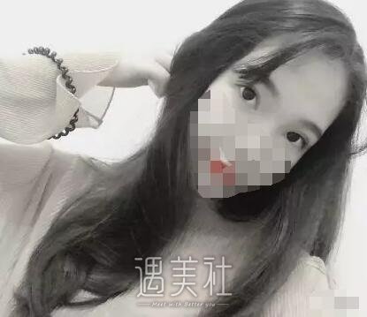 田芳斌双眼皮案例：从此告别丑丑的单眼皮小眼睛~