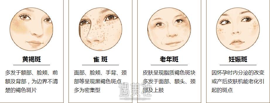 激光可以调节老年斑吗，调节果怎么样?