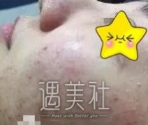八大处黄绿萍点阵激光祛痘案例：脸上光光滑滑的真好~ width=