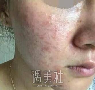 光子嫩肤祛痘