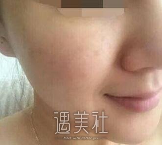 光子嫩肤祛痘