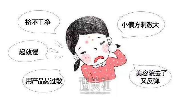 激光祛痘