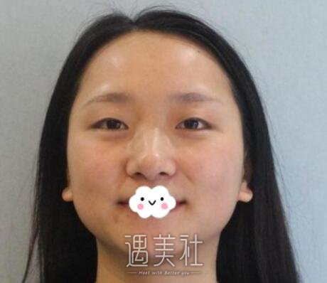 王英勇,双眼皮