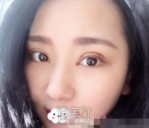 王英勇,双眼皮