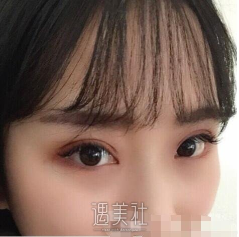 王英勇,双眼皮