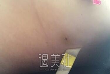 栾杰,隆胸