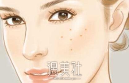 激光缩毛孔