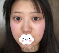 侯典举双眼皮图片分享：果真的有超出预期~ width=