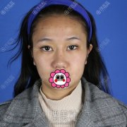 昆明艺星白春燕面部提升案例：面部轮廓恢复年轻紧致~ width=