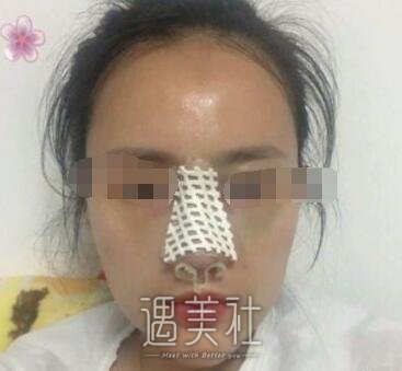 北京巫文云隆鼻案例：巫医生的手法果然娴熟!