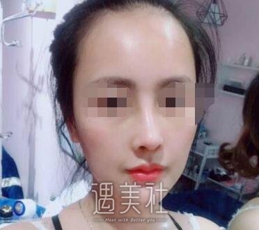 北京巫文云隆鼻案例：巫医生的手法果然娴熟!