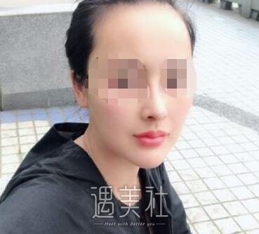 北京巫文云隆鼻案例：巫医生的手法果然娴熟!