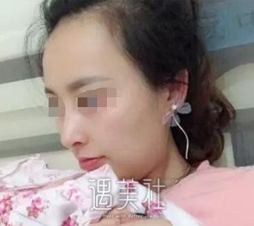 北京巫文云隆鼻案例：巫医生的手法果然娴熟!