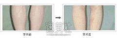 合肥打注射瘦腿瘦腿多少钱，价格和什么有关? width=
