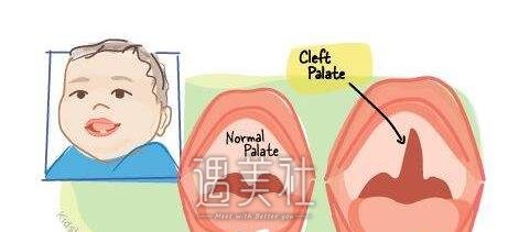 唇腭裂