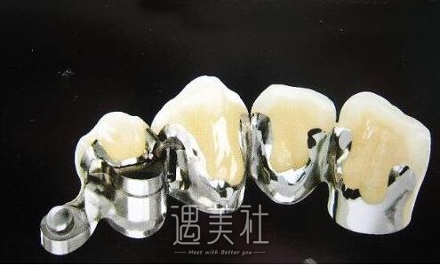 西安钴铬合金烤瓷牙售价是多少?什么影响了市场价?