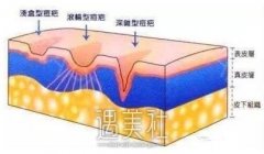 激光祛痘印痘坑有果吗，做几次有果? width=