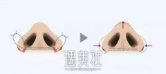南宁鼻翼整形手术有贵不贵，多少钱才合理? width=